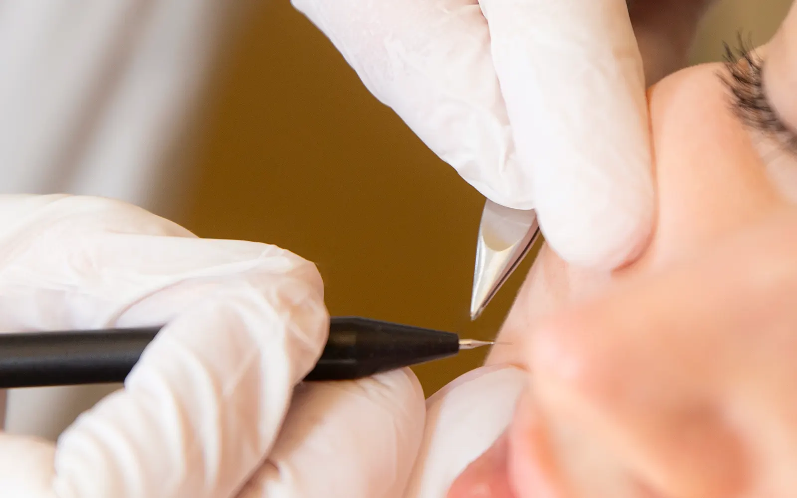 epilation-electrique électrolyse définitive Paris 17 épilation électrique permanente